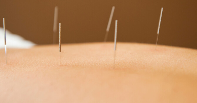 ACUPUNCTURE